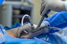 Endoscopic Procedures